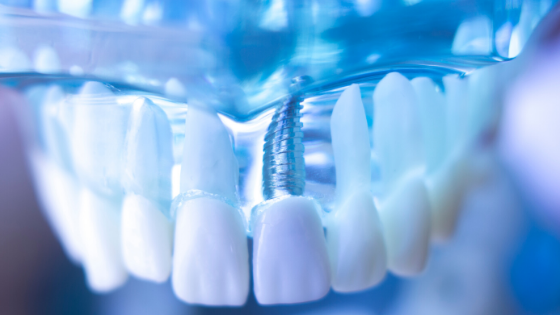 How Dental Implants Can Impact Confidence