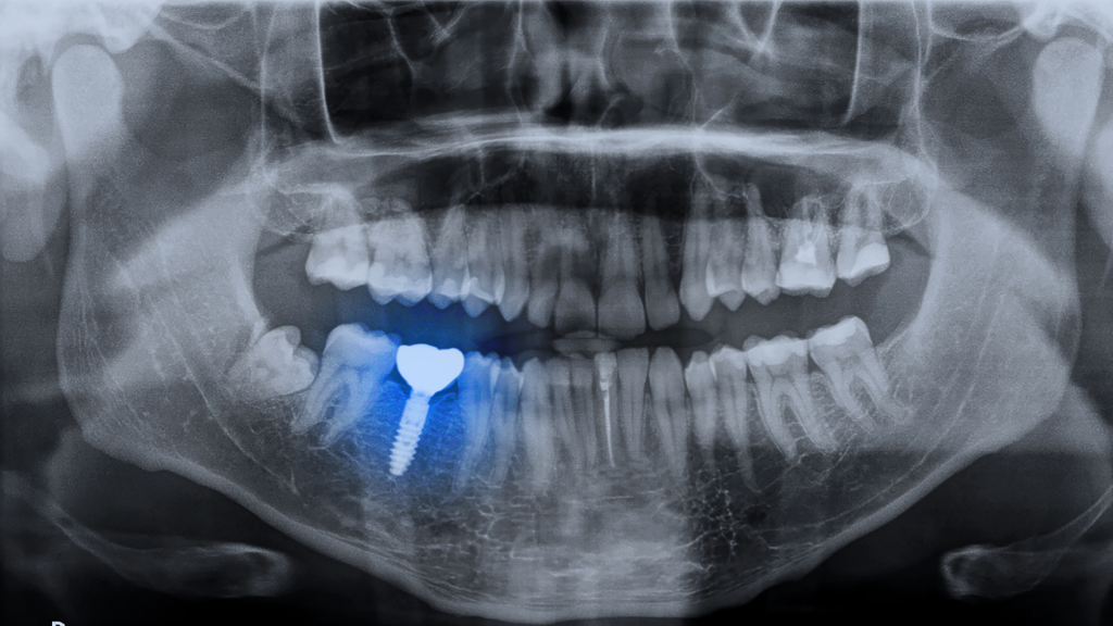 Dental implant Norman OK