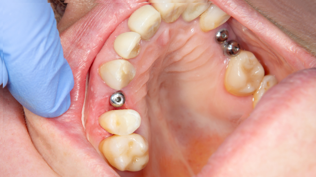 What to look for in a Dental Implant Surgery Center? Andrew Wheatley