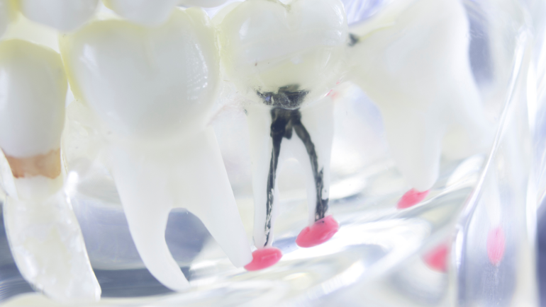 What you need to know about a root canal
