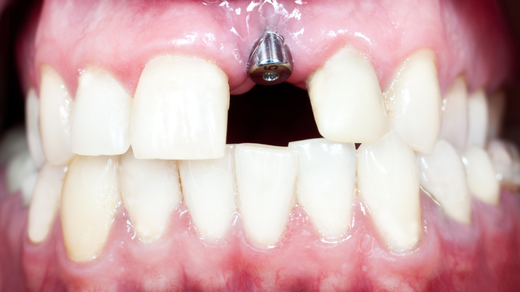 Implant dentist in Norman