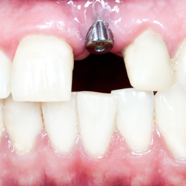 Dental Implants: How it works, recovery time, how to care for them