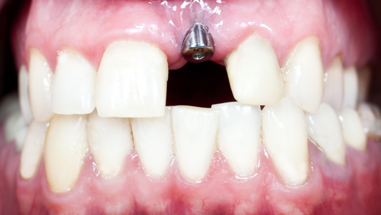 Dental Implants: How it works, recovery time, how to care for them