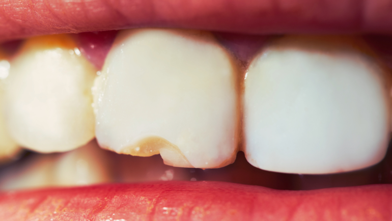 Can a cracked tooth heal itself?