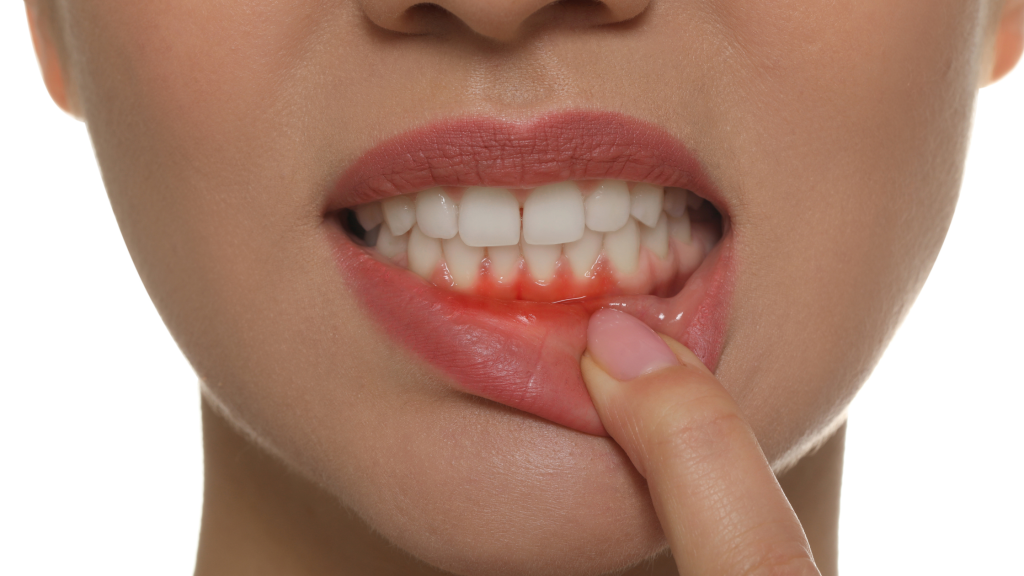 Swollen gums