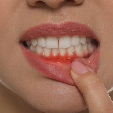 Are swollen gums a bad sign?