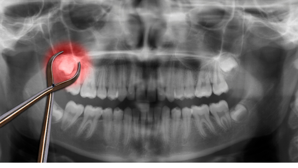 Wisdom tooth extractions Andrew Wheatley, DDS at Tecumseh Ridge Dental in Norman